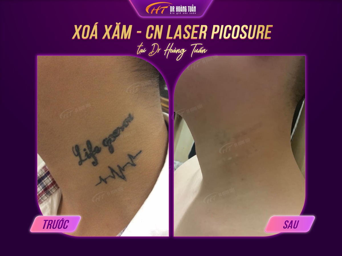 hình ảnh sau khi xóa xăm